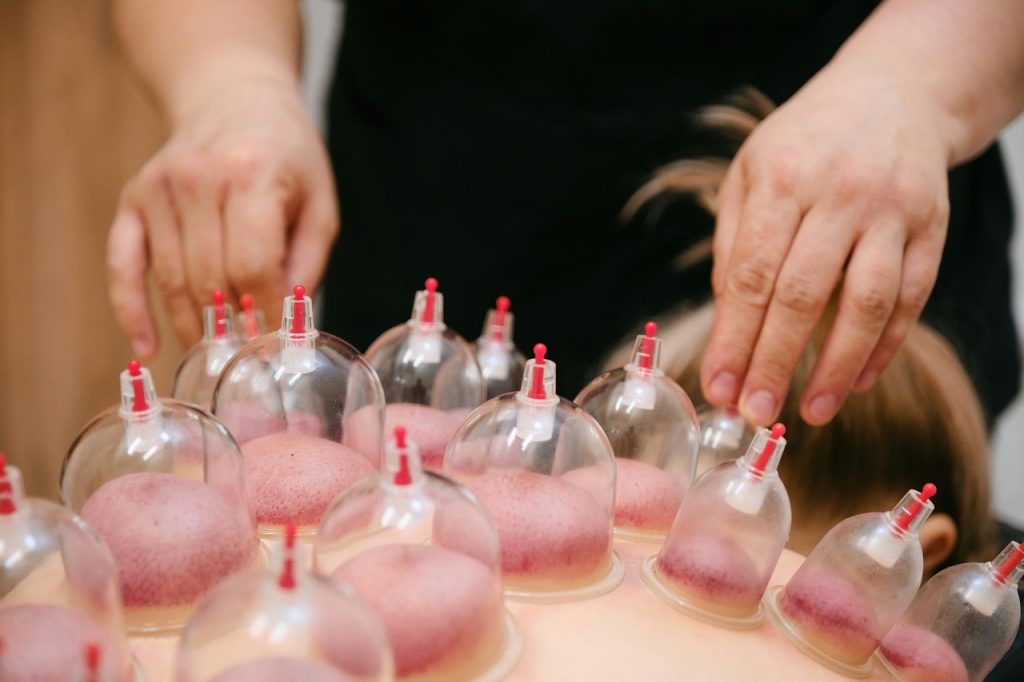 cupping therapy
